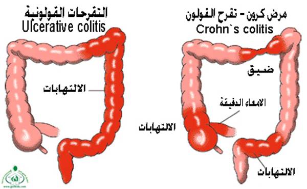 ���� Crohn`s Disease